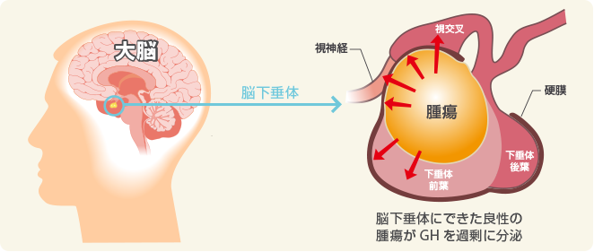 先端巨大症に関する簡単な事実