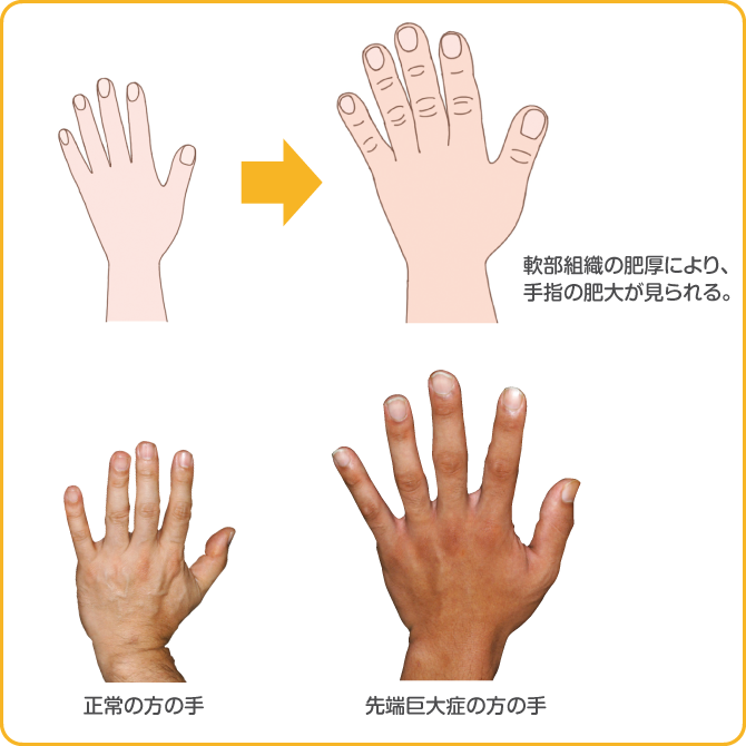 先端巨大症で見られる手指の肥大